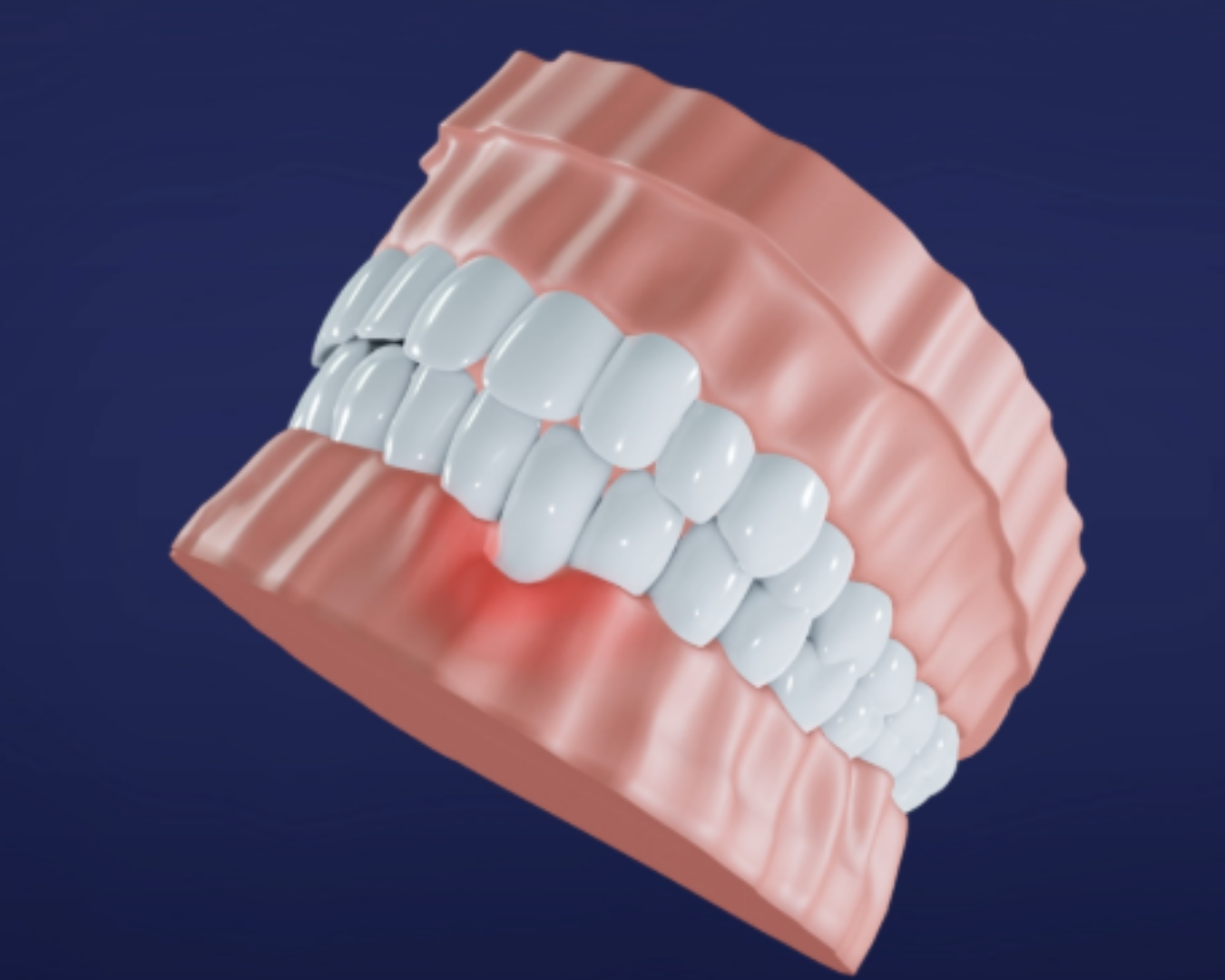 Tooth Pain
