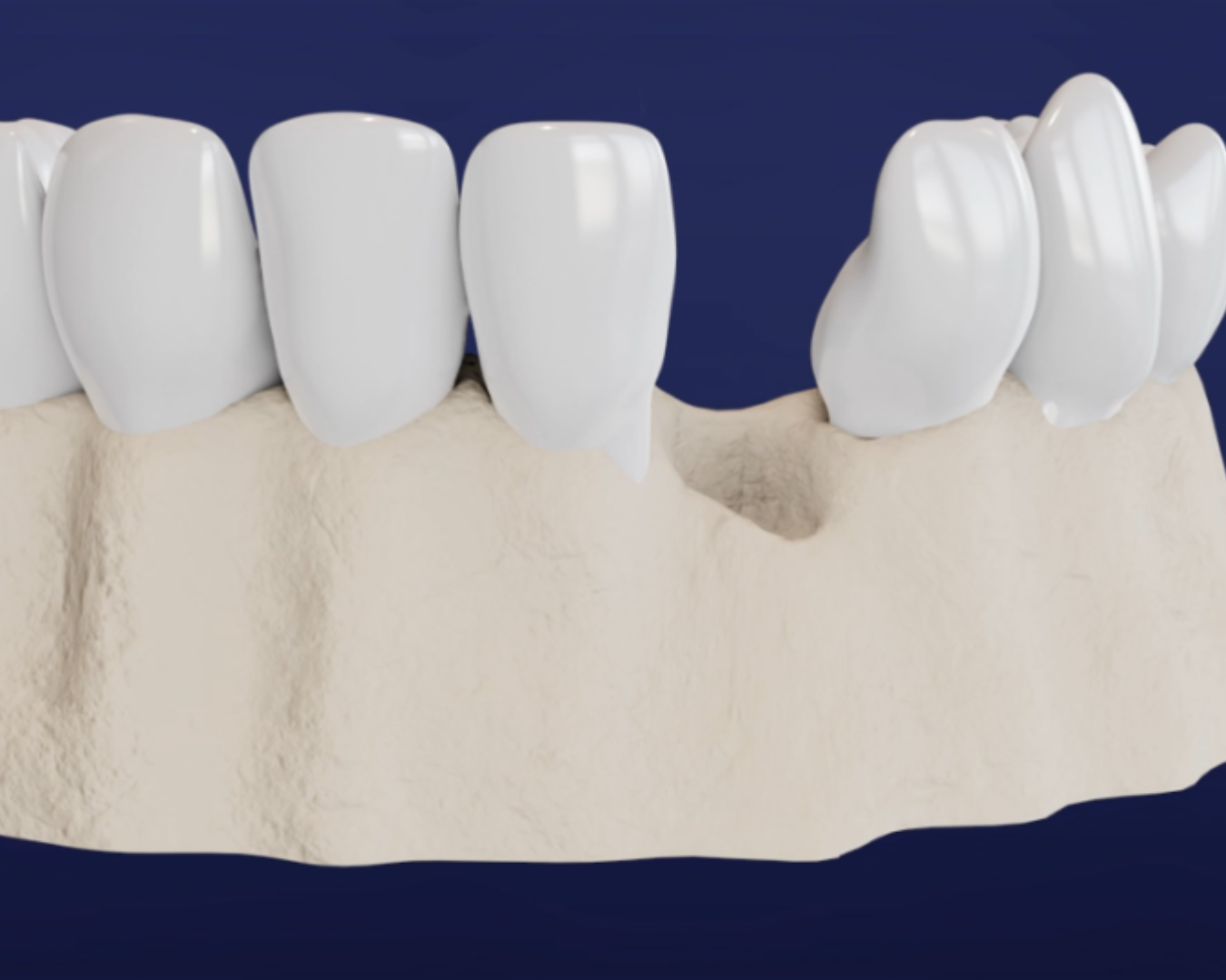 Tooth Extraction