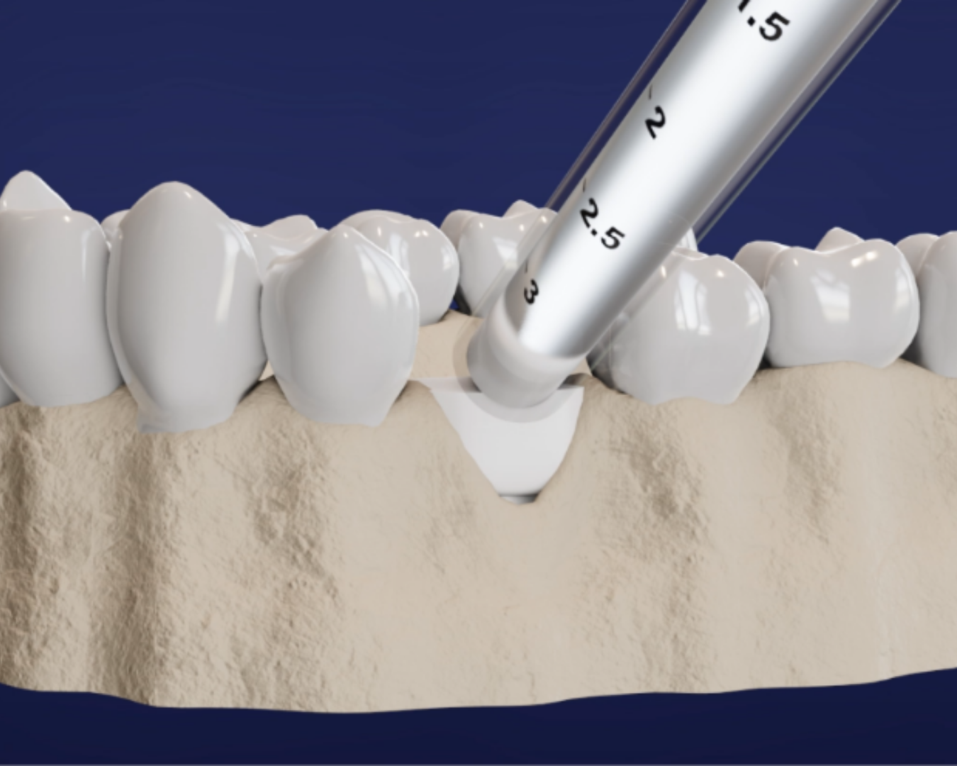 Dental Bone Graft Procedure