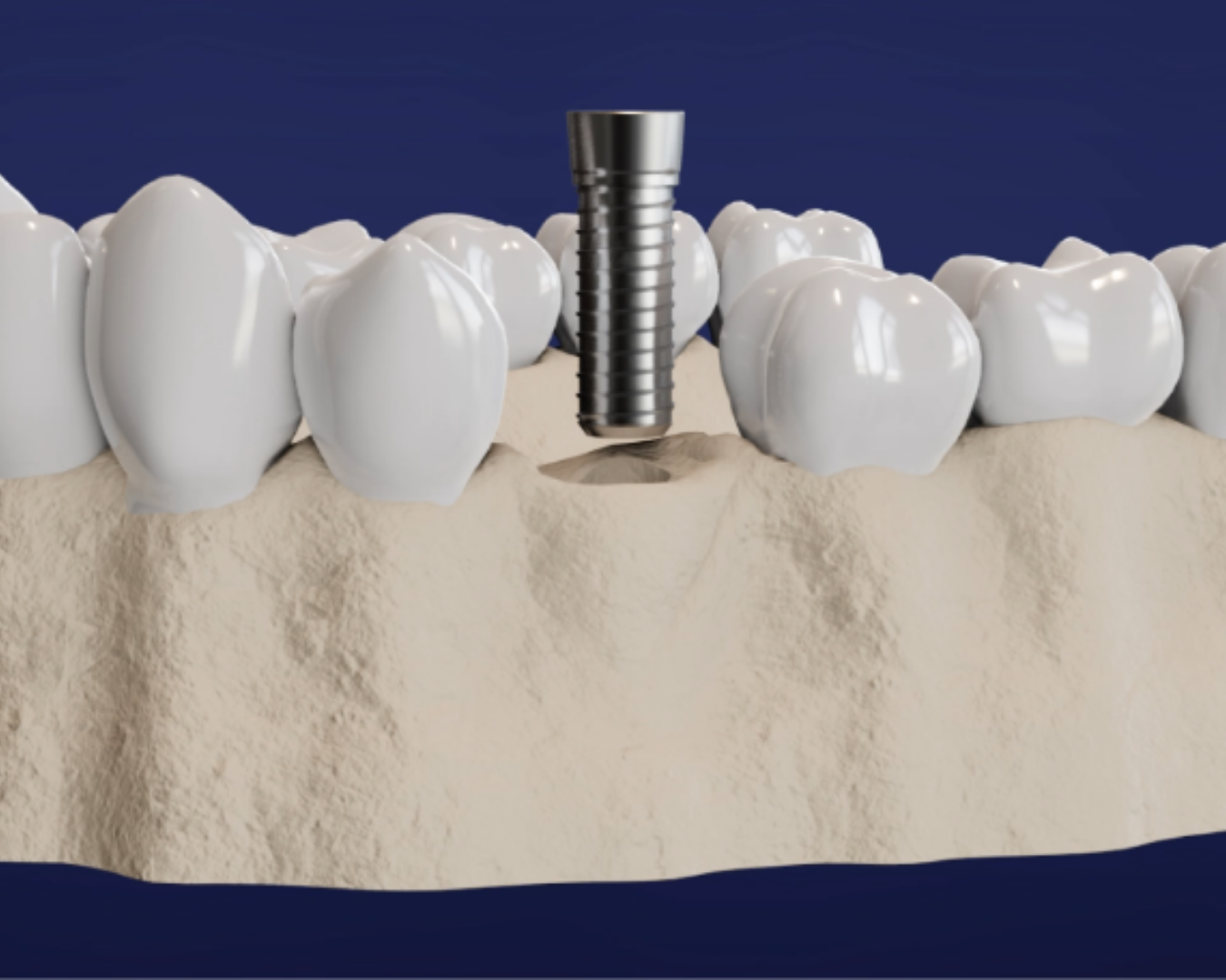 Implant Screw Fitting