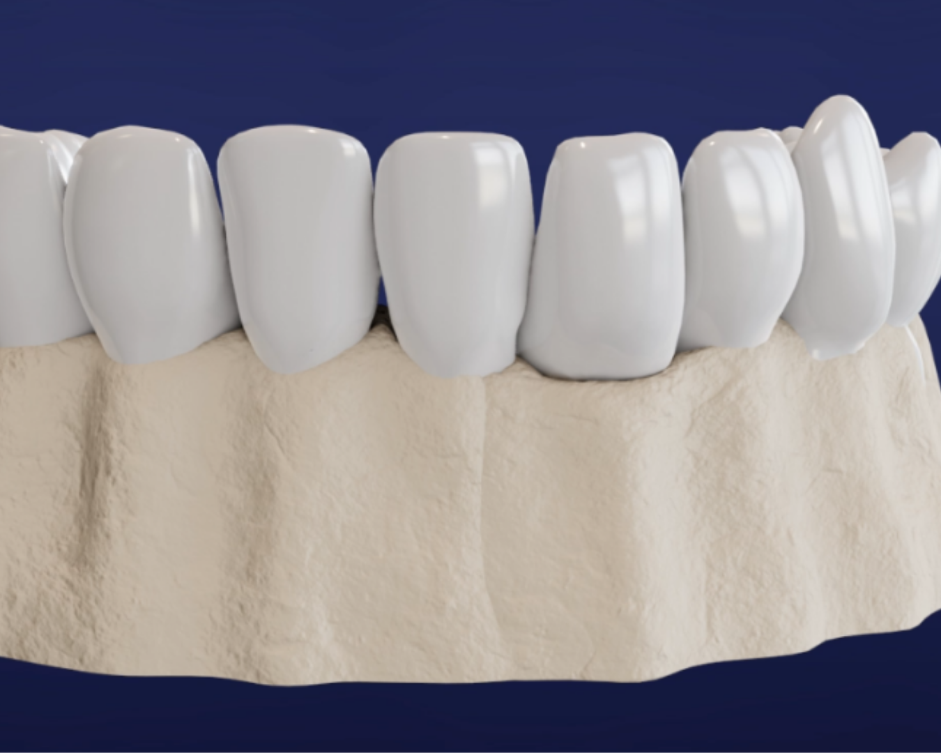 Crown added to dental implant