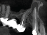 Initial CBCT