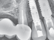 Radiograph 4 months post-op - Fit final crown