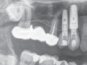 Radiograph 5 years post-op