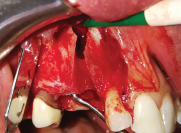Defect after cyst removal