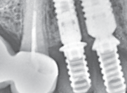 Post-op radiograph