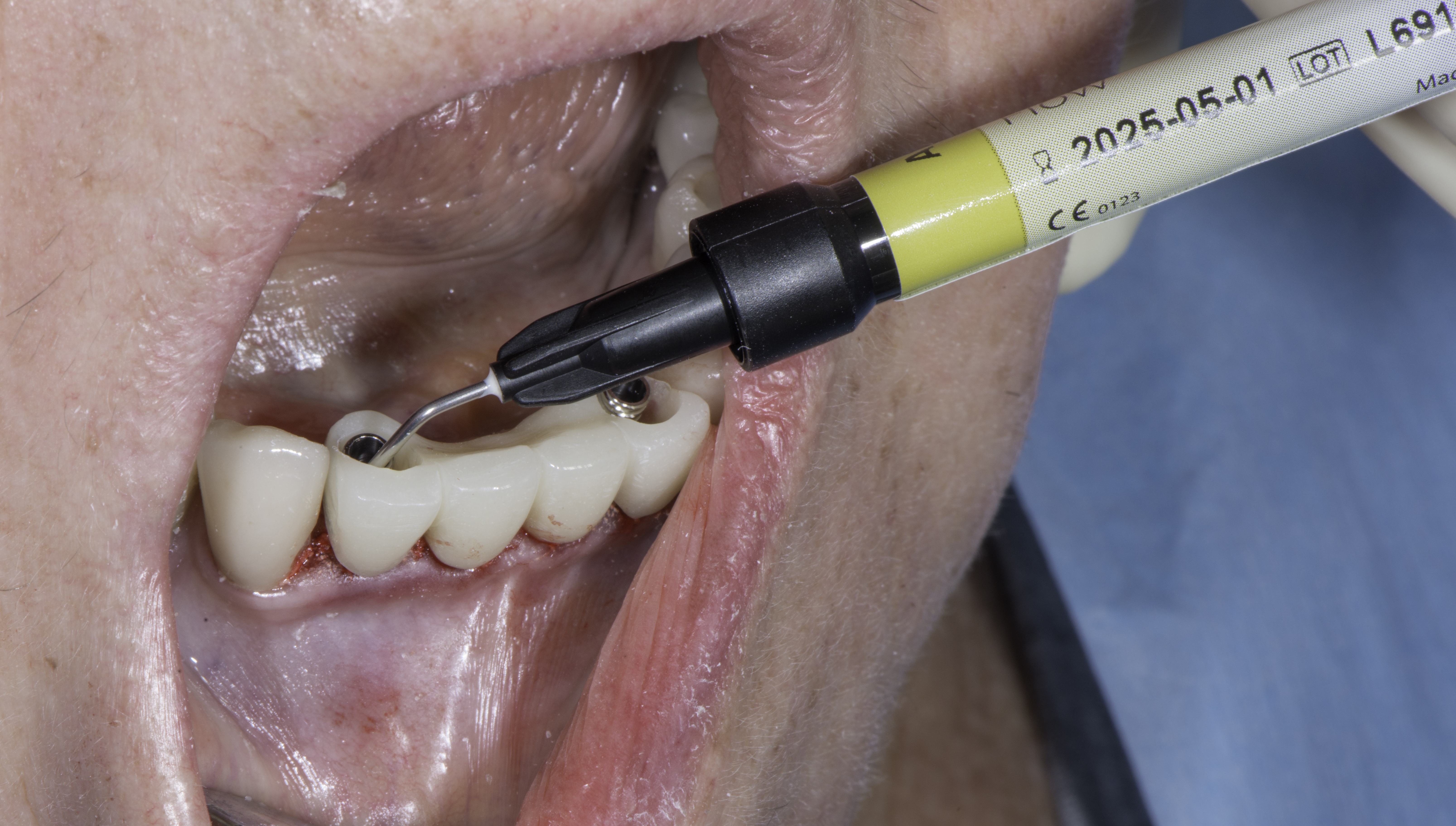 Techniques and Protocols with EthOss | EthOss Dental