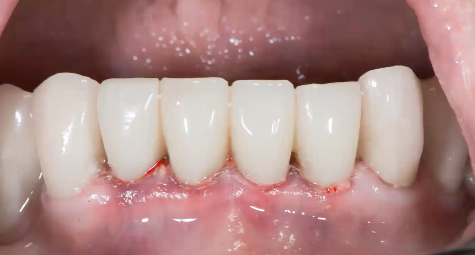 Supporting image for the Elevating Bone Regeneration: EthOss Insights and Innovations webinar. Image shows a row of bottom teeth, slightly bloody, with pale pink gums