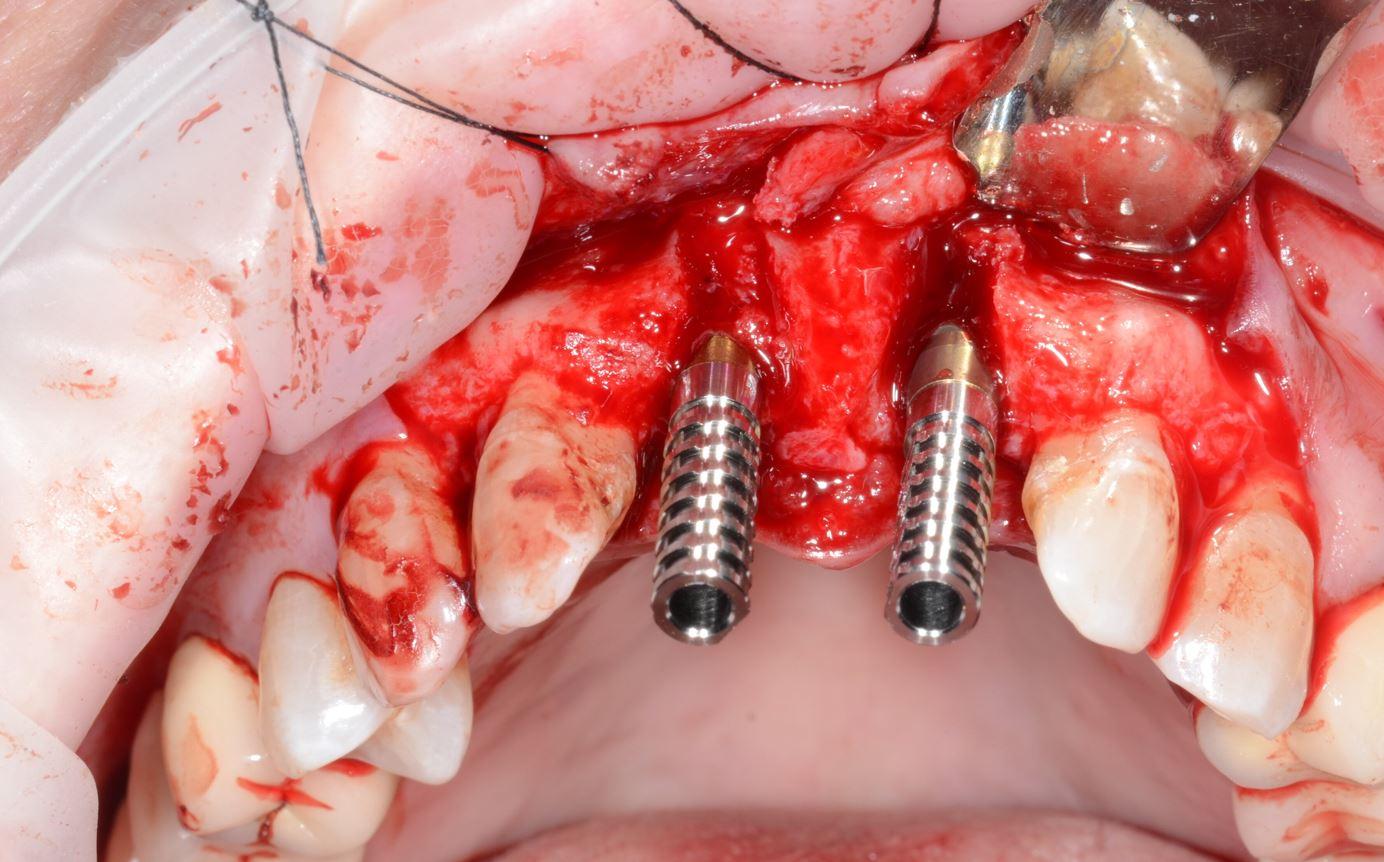 Image supporting EthOss Case Studies page. Image shows a graphic picture of two implants placed in the gum.