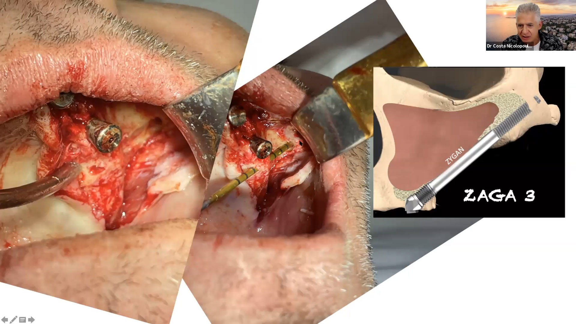 Immediate Implant Placement with Immediate Loading | EthOss Dental